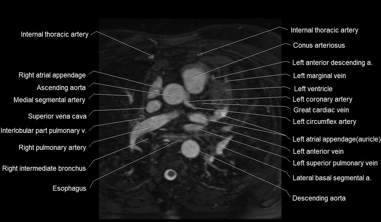 MRI heart coronary arteries and coronary veins anatomy axial image 12.webp